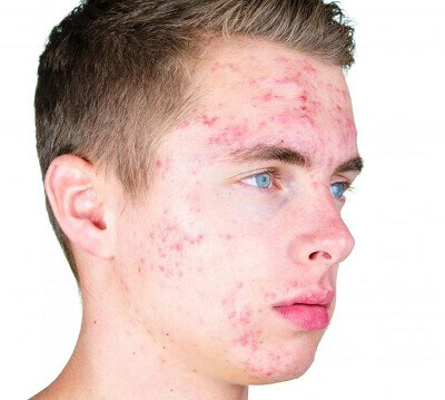 Позбавлення від підліткових прищів Позбавлення від підліткових прищів