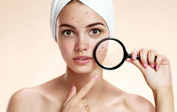 Аспірин від прищів Аспірин від прищів