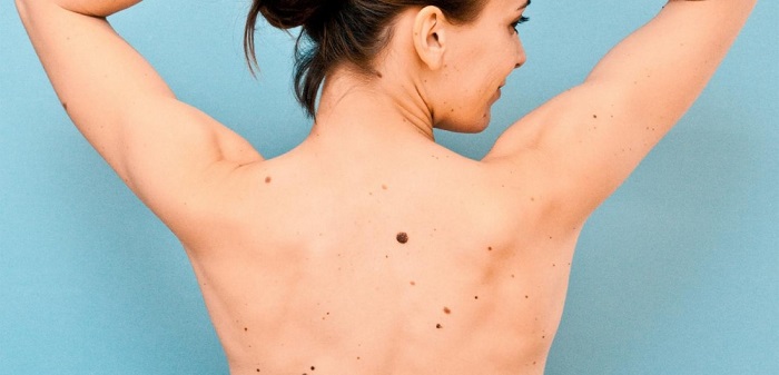 Що можуть означати родимі плями на тілі? Що можуть означати родимі плями на тілі?