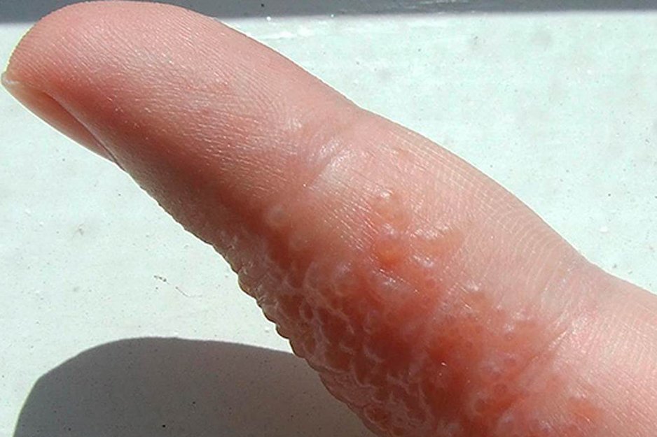 Герпес на руках: симптомы, лечение