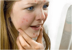 Как быстро избавиться от болячки после прыща: медикаменты, рецепты Как быстро избавиться от болячки после прыща: медикаменты, рецепты