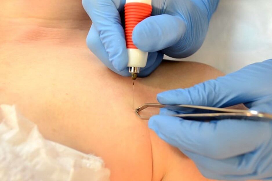 Можно ли удалять папилломы на теле: как сделать правильно?