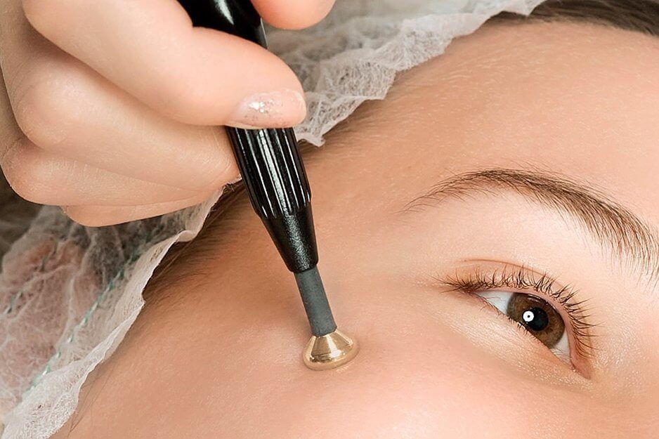 Можно ли удалять папилломы на теле: как сделать правильно?