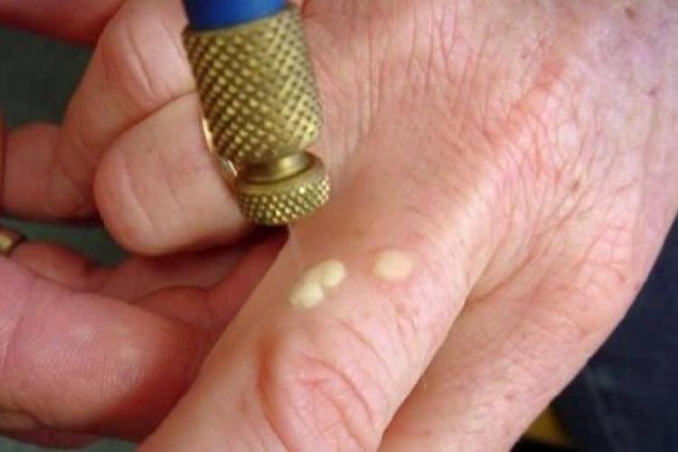 Можно ли удалять папилломы на теле: как сделать правильно?