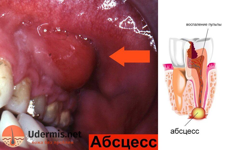 Прыщ на десне над зубом: причины, лечение Прыщ на десне над зубом: причины, лечение