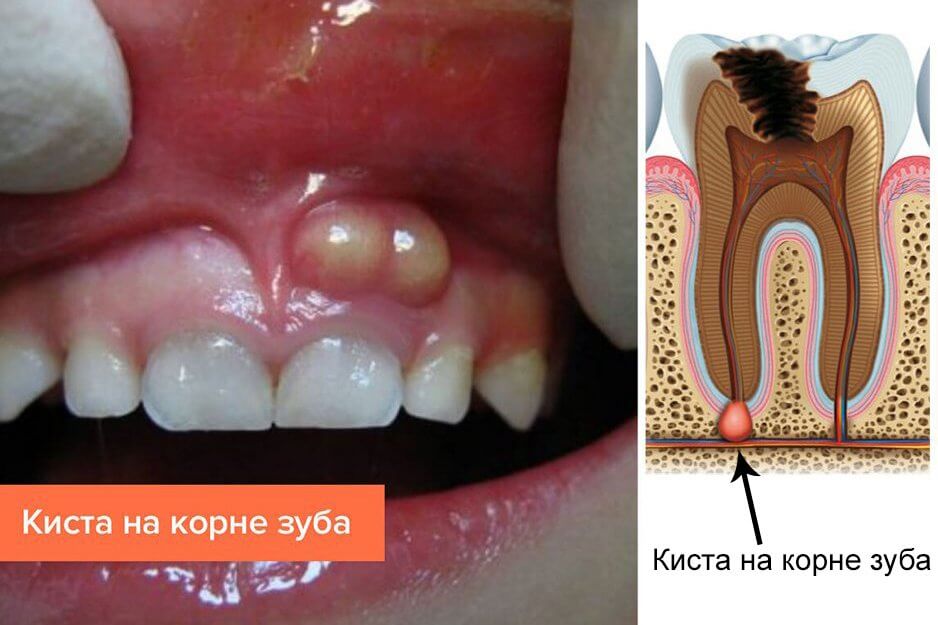 Прыщ на десне над зубом: причины, лечение Прыщ на десне над зубом: причины, лечение