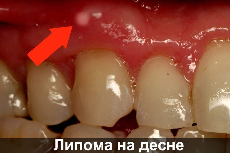 Прыщ на десне над зубом: причины, лечение Прыщ на десне над зубом: причины, лечение