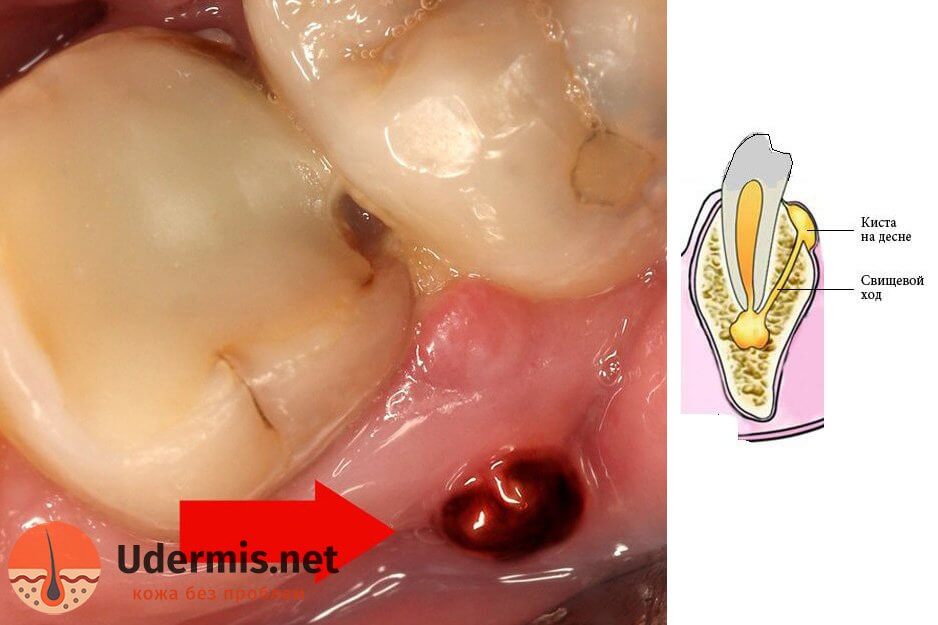 Прыщ на десне над зубом: причины, лечение