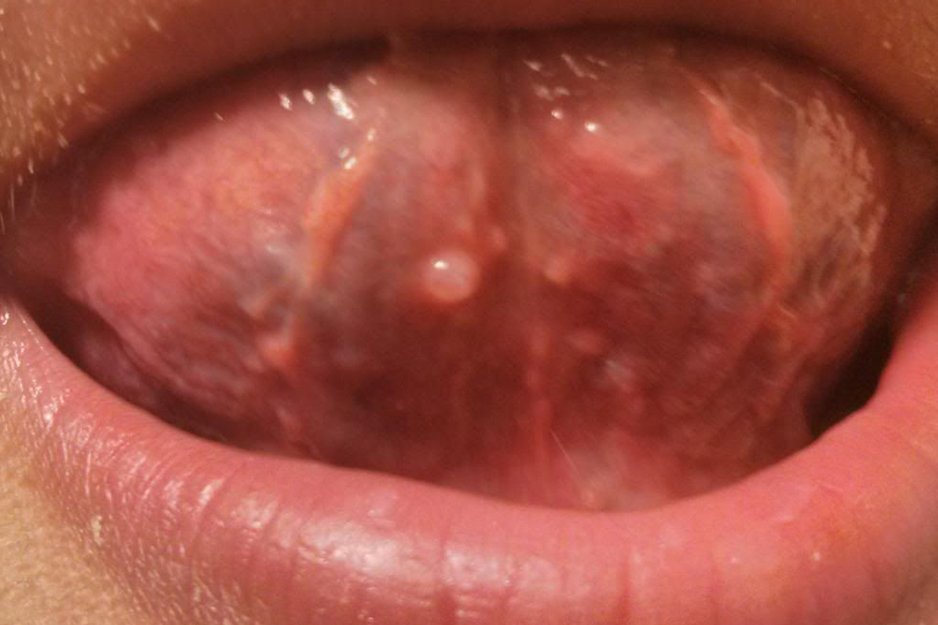 прищі під язиком