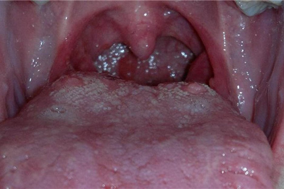 прищі на корені язика