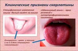 Прыщ в горле: как лечить, причины, диагностика Прыщ в горле: как лечить, причины, диагностика