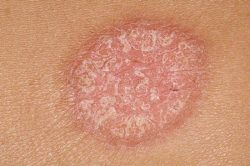 Прыщи на члене: что делать, лечение и причины Прыщи на члене: что делать, лечение и причины