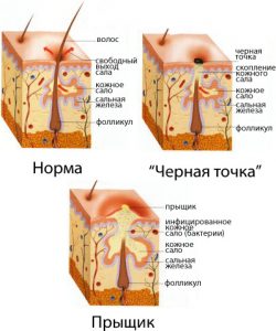 Прыщи на голове: причины, лечение, виды и как предупредить Прыщи на голове: причины, лечение, виды и как предупредить