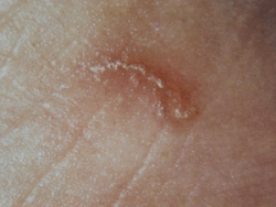 Прыщи на руках: как лечить, причины, какие бывают виды Прыщи на руках: как лечить, причины, какие бывают виды