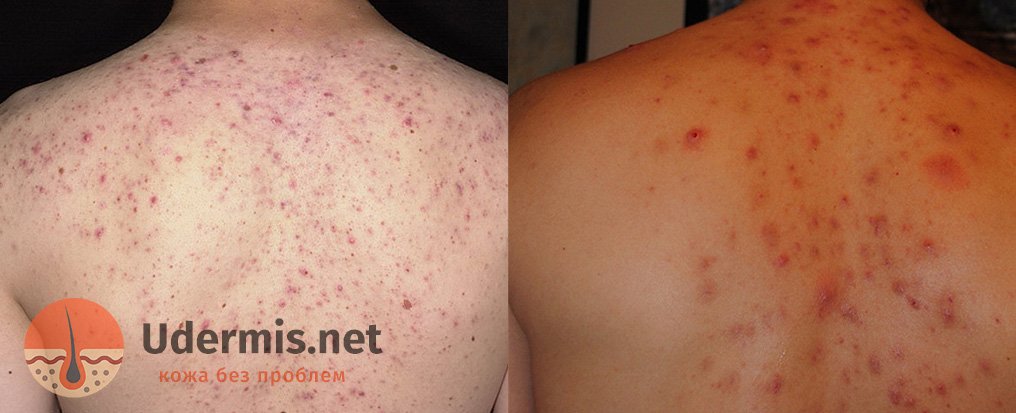 Прыщи на спине у мужчин: причины и как избавиться