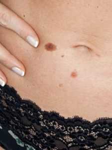 Прыщи на животе: причины, как лечить, профилактика Прыщи на животе: причины, как лечить, профилактика