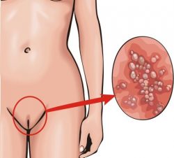 Прыщи во влагалище: лечение, причины, профилактика Прыщи во влагалище: лечение, причины, профилактика