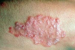 Зуд кожи при прыщах: что делать с проблемой, причины Зуд кожи при прыщах: что делать с проблемой, причины