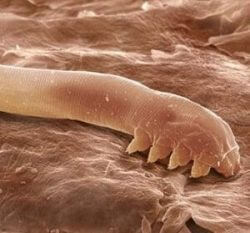 Зуд кожи при прыщах: что делать с проблемой, причины Зуд кожи при прыщах: что делать с проблемой, причины