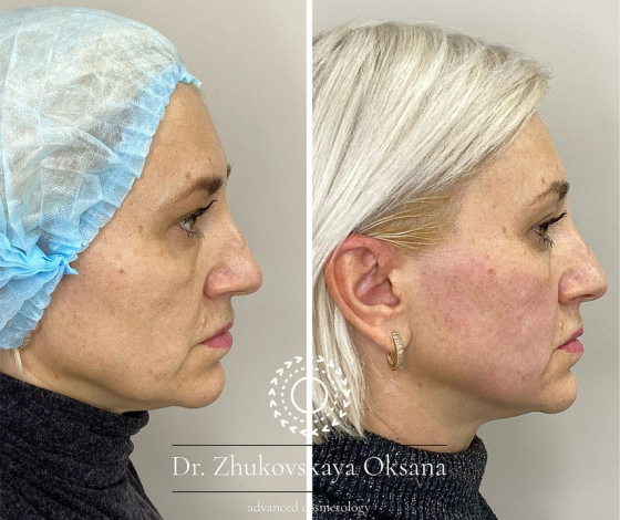 Як «пригальмувати» старіння за допомогою SMAS-ліфтингу: розповідає косметолог Оксана Жуковська