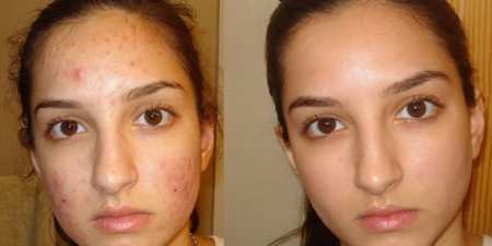 Уколи краси для обличчя: процедури для омолодження шкіри