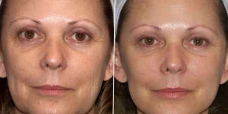 Уколи краси для обличчя: процедури для омолодження шкіри