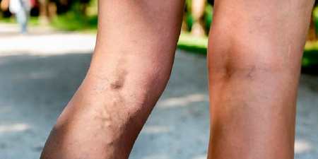 Фотоомолодження шкіри — протипоказання, можливі наслідки