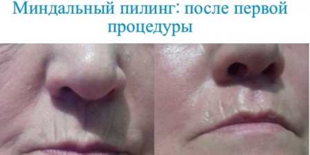 Кислотний пілінг для обличчя в домашніх умовах — який вибрати