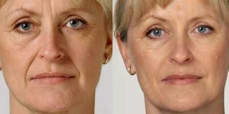 Уколи краси для обличчя: процедури для омолодження шкіри
