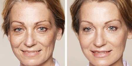 Уколи краси для обличчя: процедури для омолодження шкіри