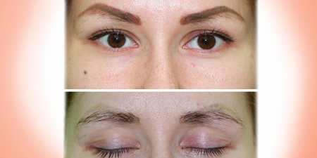 Лазерне видалення татуажу брів — переваги і недоліки методу, ускладнення