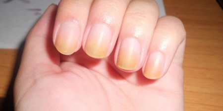 Як відбілити нігті і позбутися від жовтизни на руках або ногах — список найбільш ефективних препаратів