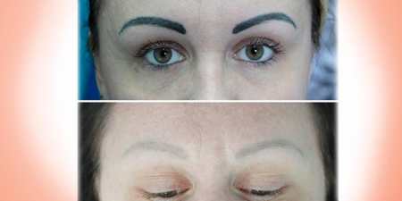 Лазерне видалення татуажу брів — переваги і недоліки методу, ускладнення