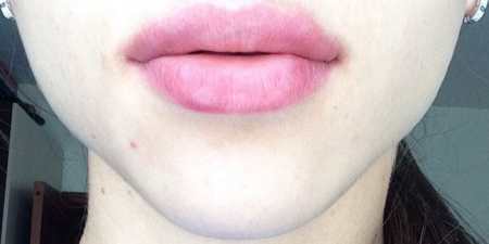 Філлери для губ — показання для корекції або збільшення, рейтинг засобів та етапи процедури з фото