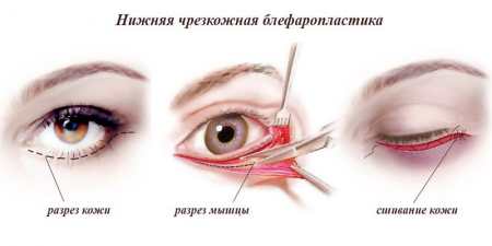 Лазерна блефаропластика: операція і відгуки