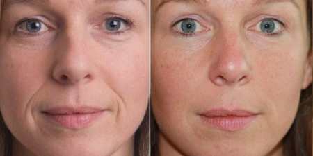 Скульптурний масаж обличчя — суть методу, тривалість курсу і результати з фото до і після