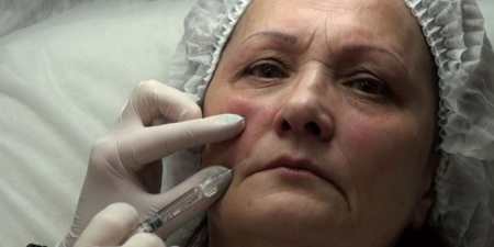 Контурна пластика носогубних складок — чим заповнюють, вибір філерів, ускладнення і відгуки