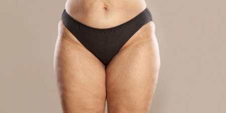 Розтяжки на ногах — причини виникнення, методи лікування в домашніх умовах, салонні процедури, профілактика, фото