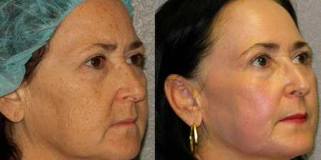 Міостимуляція обличчя — апарати для проведення в домашніх умовах, користь і шкода, відгуки, фото до і після