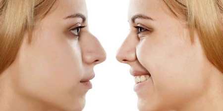 Безопераційна ринопластика: методи і наслідки