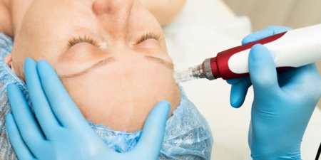 Фракційна мезотерапія: показання до застосування та ефективність процедури, відгуки про омолодження