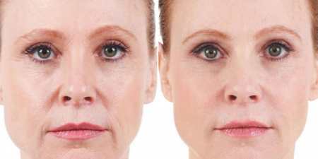 Уколи краси — види і особливості ін’єкцій, склад, показання, результати, протипоказання та наслідки