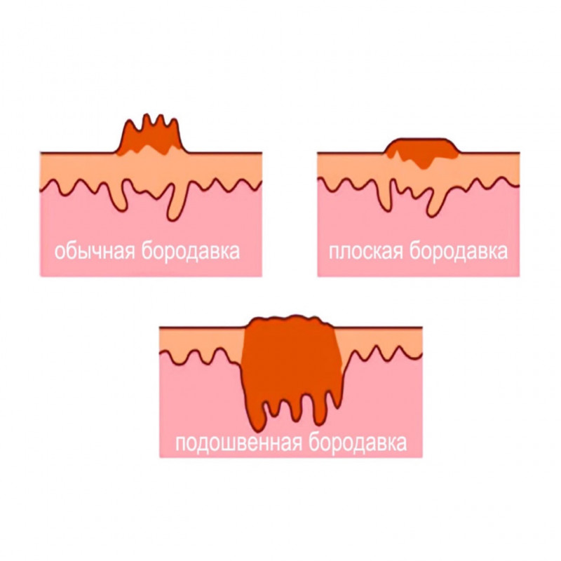 Бородавки - що треба знати про способи їх видалення