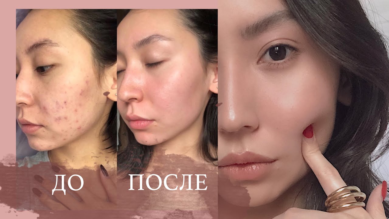 Як позбутися постакне в домашніх умовах