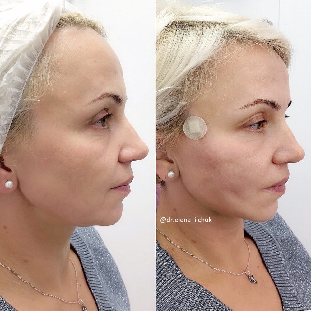 Нитки коги для підтяжки обличчя – реабілітація після встановлення та результати