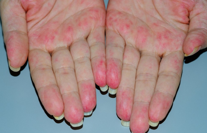 Васкуліт як у Ештона Катчера: що це за хвороба та як її вчасно помітити