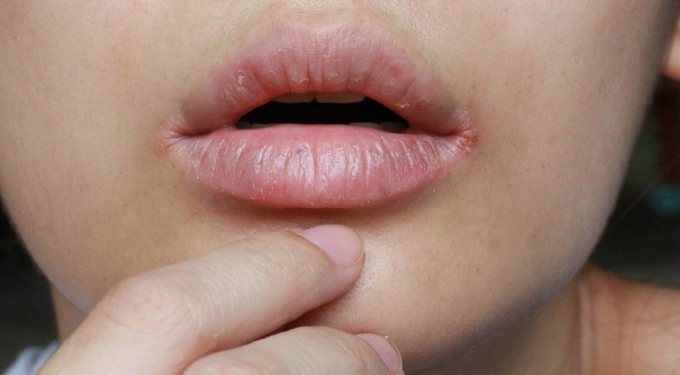 Чим лікувати заїди в куточках рота: 4 головні методи та 4 найкорисніші засоби народної медицини