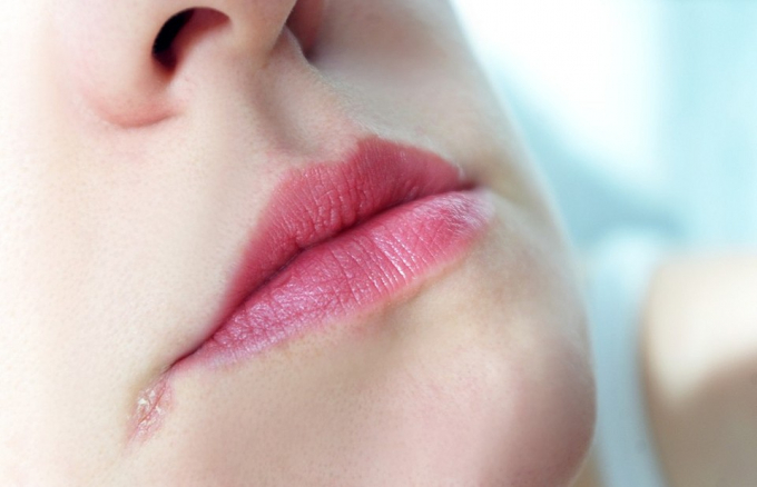 Чим лікувати заїди в куточках рота: 4 головні методи та 4 найкорисніші засоби народної медицини