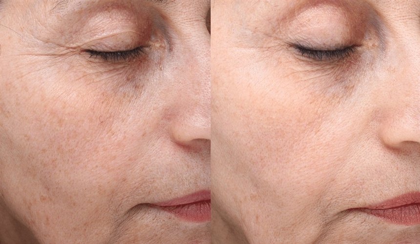 Що таке фотоомолодження особи