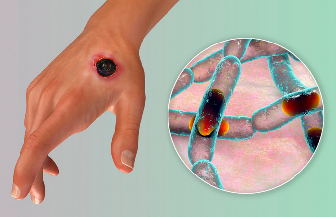 Симптоми сибірки у людини: чи є лікування і чи можна захиститися від хвороби